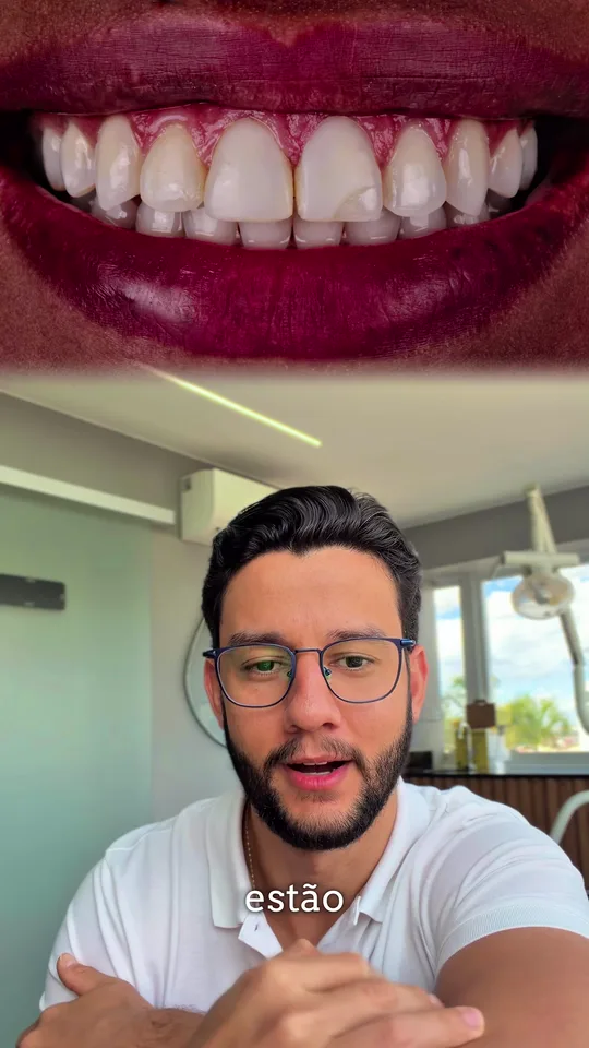 Caso de paciente com uso de facetas