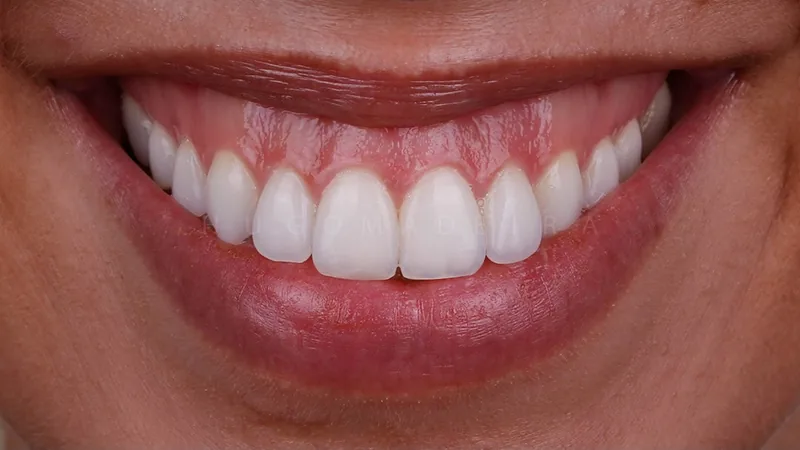 Periodontia na Brasil Implantes